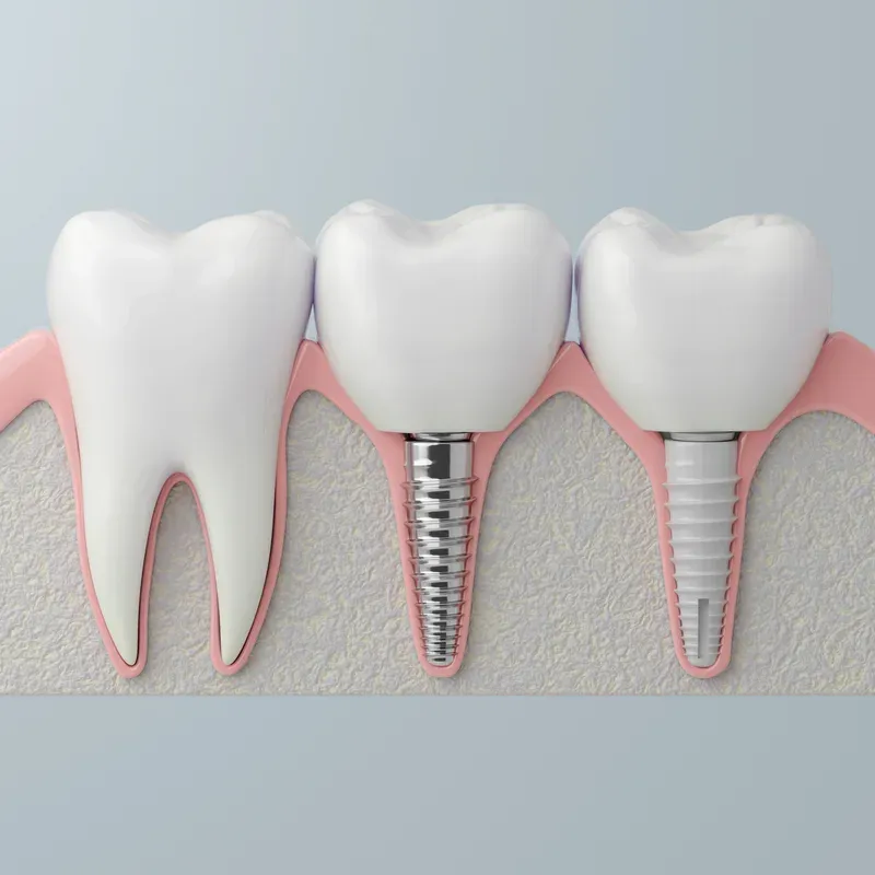 Anonymized implant dental ad, active 13 days